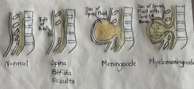 Types of Spina Bifida