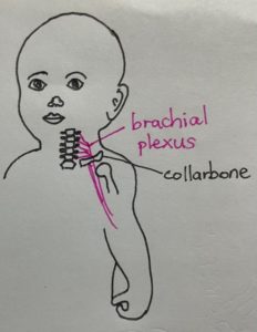 brachial plexus injury in newborn baby infant