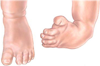 How to recognise if my baby's feet are normal or needs treatment? Clubfoot,  baby feet turning inward or outward