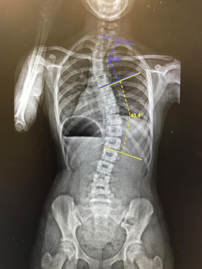 Scoliosis Spine X Ray