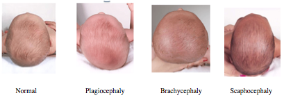 different types of plagiocephaly (flat head)
