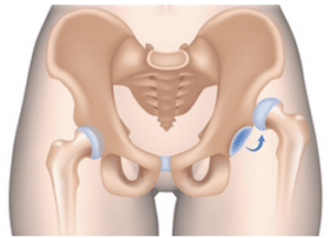 hip dislocation subluxation