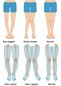 knock-kneed vs bow-legged pic