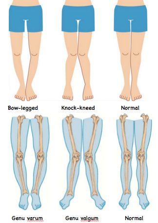 Knock-knees and Bow-legs - Physiotherapy for Kids (Singapore)