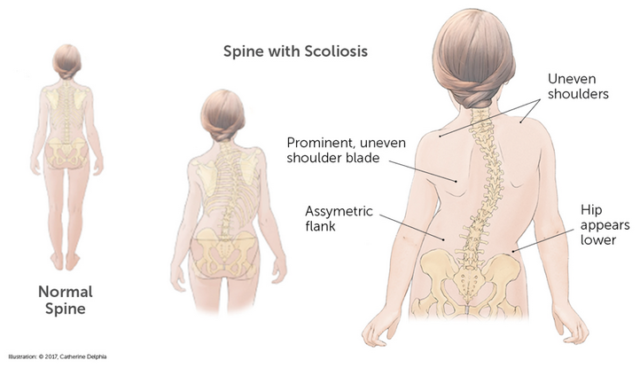 signs of scoliosis in teens