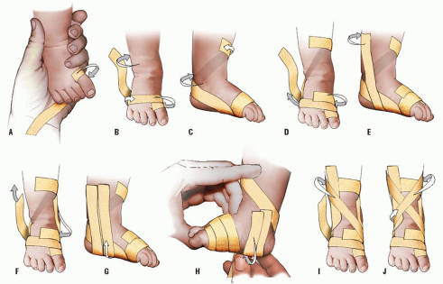 Clubfoot (CTEV) - Physiotherapy For Kids (Singapore)