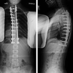 surgery for scoliosis